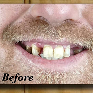 Professional Cosmetic Upper - New from Instant Smile! Hand Crafted Detail, Custom fit at Home! Works Best in Medium to Large Sized Mouths.
